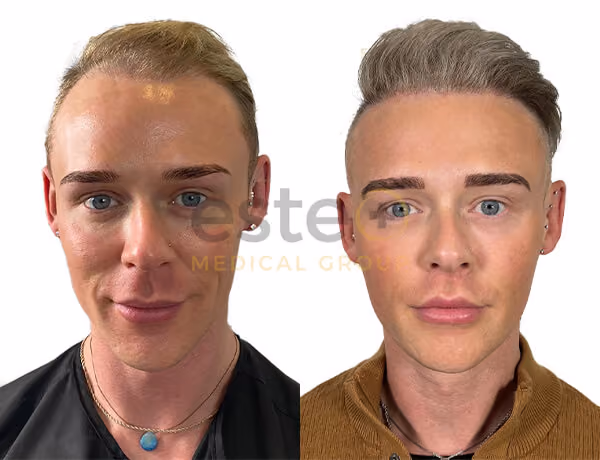Hair transplant before and after Leeds