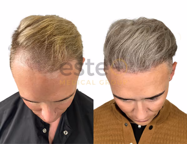 Hair transplant before and after Leeds