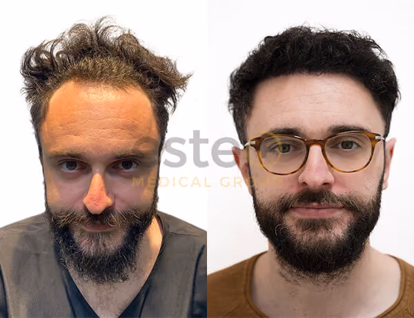 Hair transplant before and after Leeds