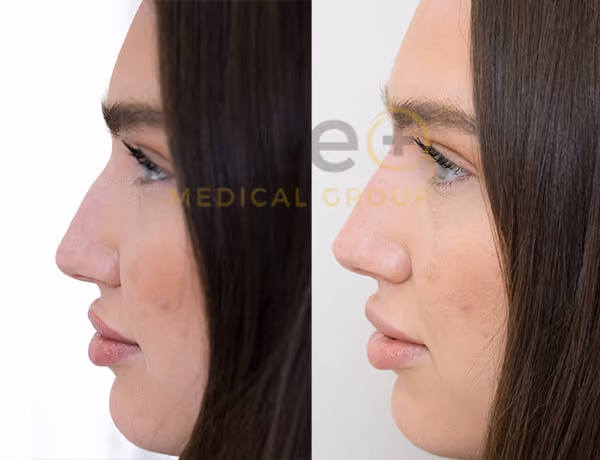 Jo _ Nose Fillers - Este