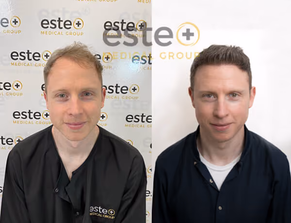Hair transplant before and after Leeds
