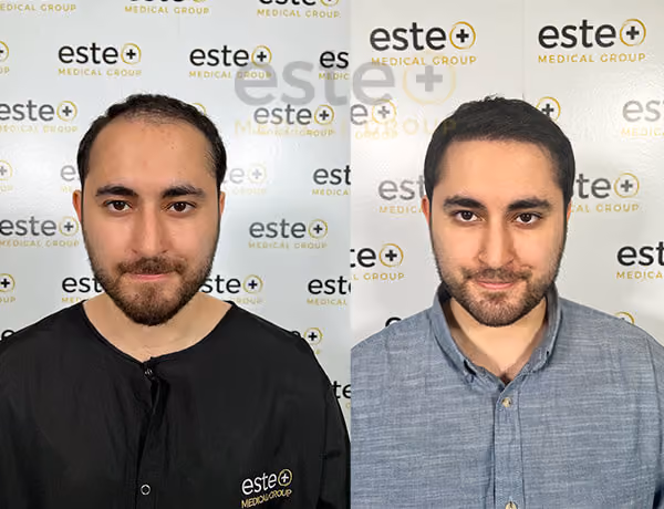 Hair transplant before and after Leeds