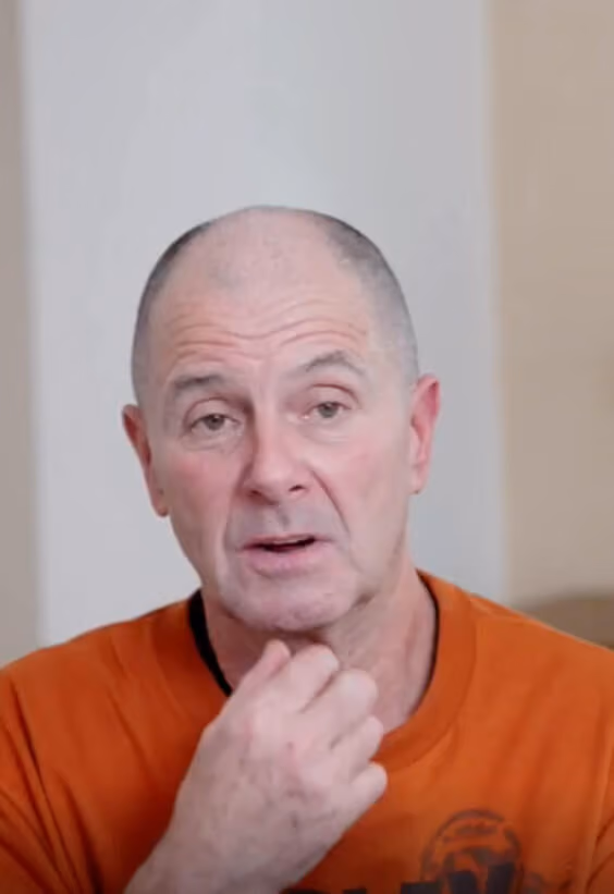 Ian - Dental Implants before after images