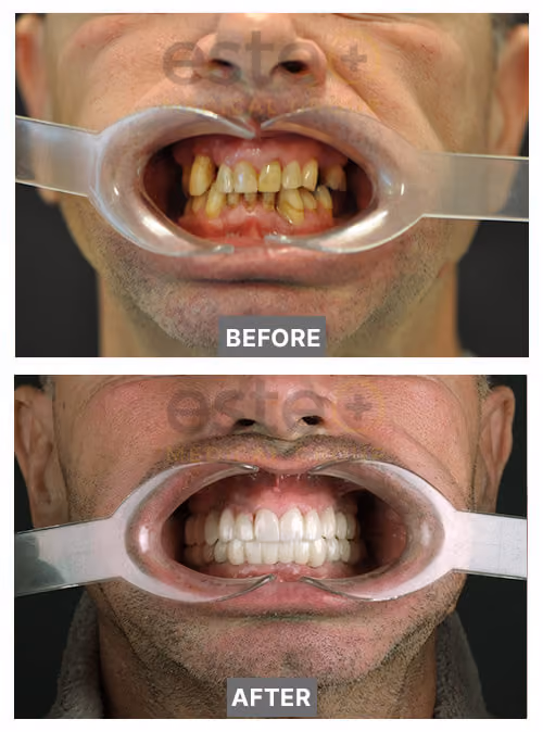 Ian - Dental Implants before after images