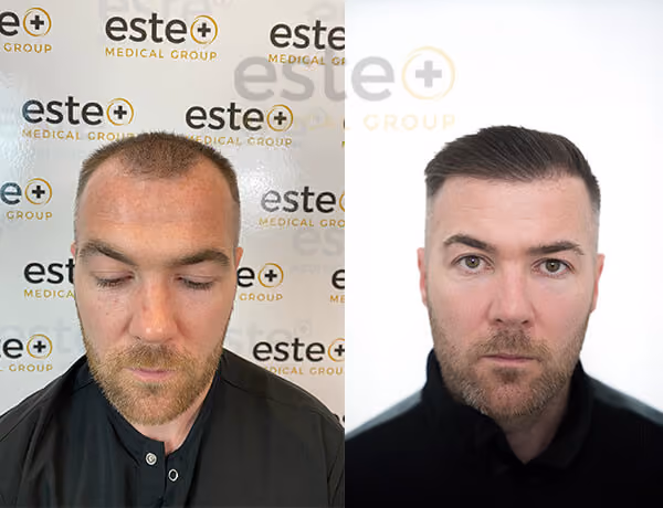 Hair transplant before and after Leeds