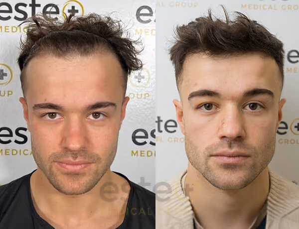 Hair transplant before and after Leeds