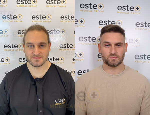 Hair transplant before and after Leeds