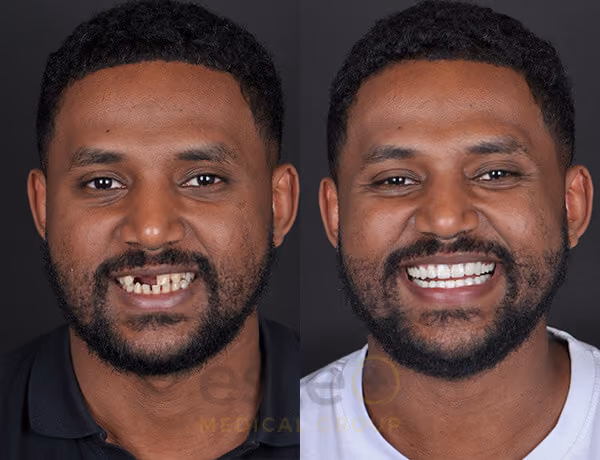 Samuel Dental missing tooth before after results 