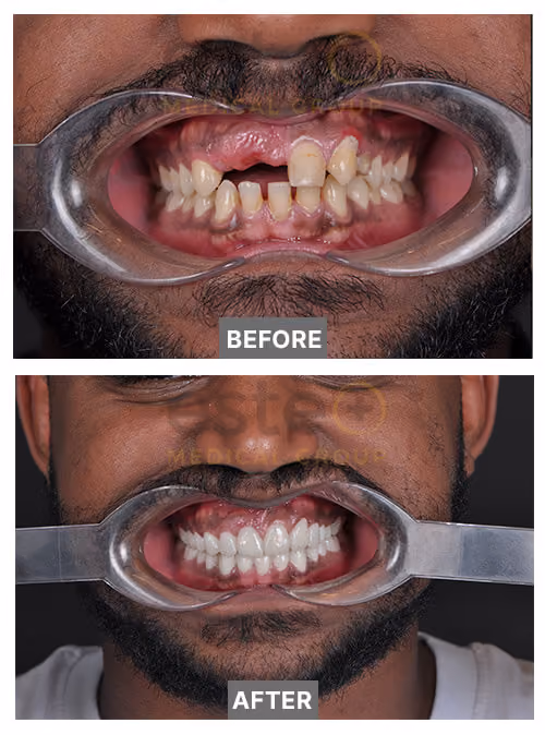 Samuel Dental missing tooth before after results 