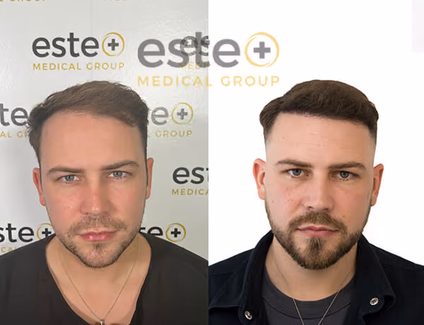 Hair transplant before and after Leeds