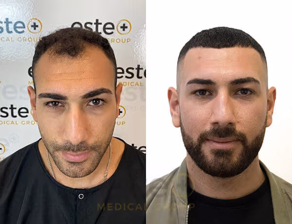 Hair transplant before and after Leeds