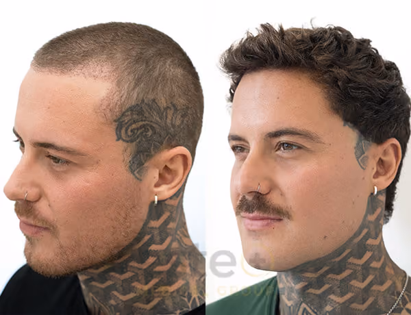 Hair transplant before and after Leeds