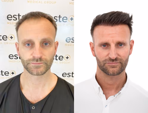 Hair transplant before and after Leeds