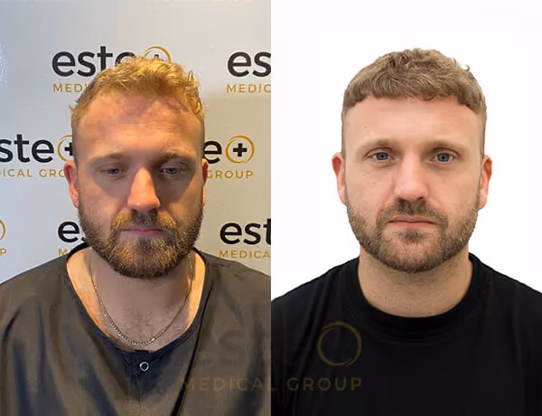 Hair transplant before and after Leeds