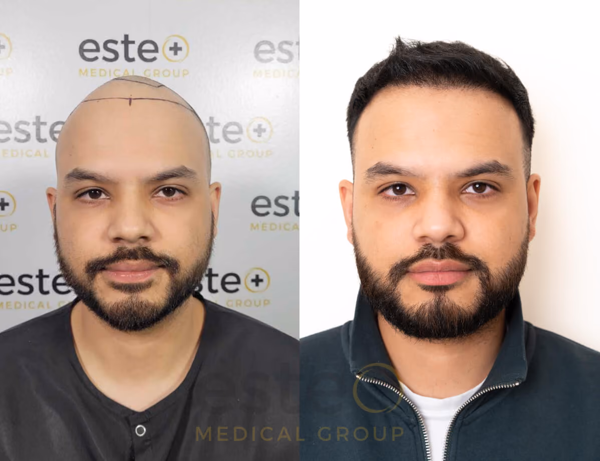 Hair transplant before and after Leeds