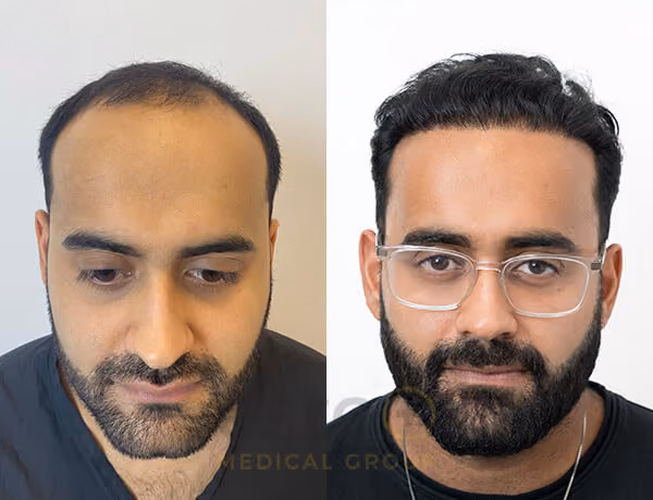 Hair transplant before and after Leeds
