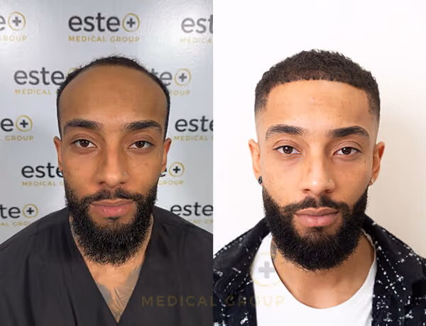 Hair transplant before and after Leeds
