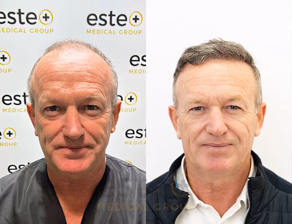 Hair transplant before and after Leeds