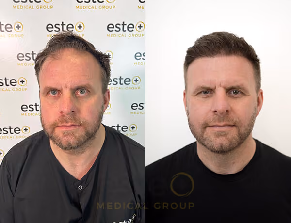 Hair transplant Men