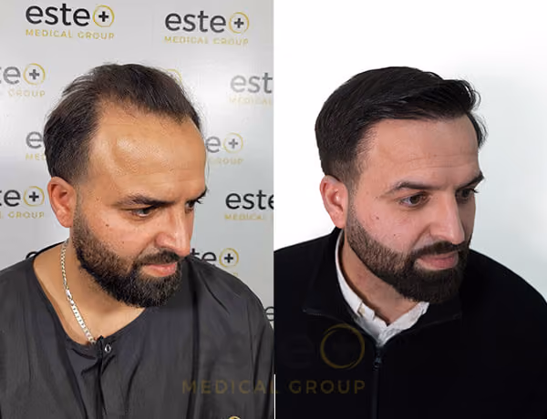 Hair transplant Men