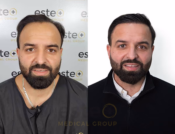 Hair transplant Men