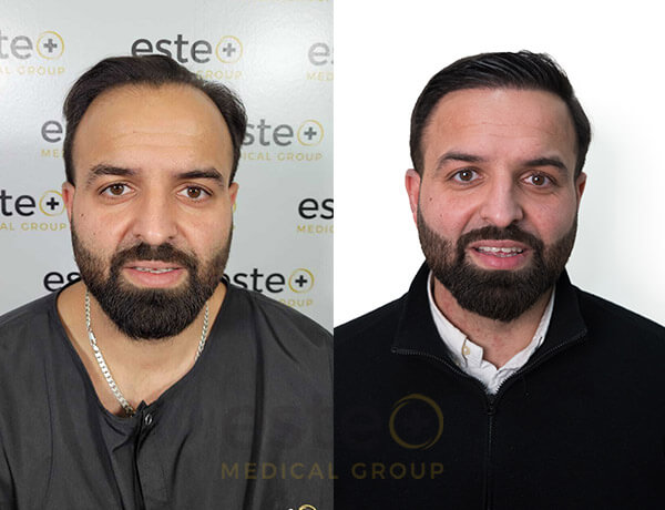 Shiva Peters Hair transplant results with Este