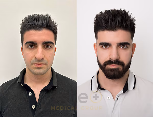 Nose job before-after results with Este Medical