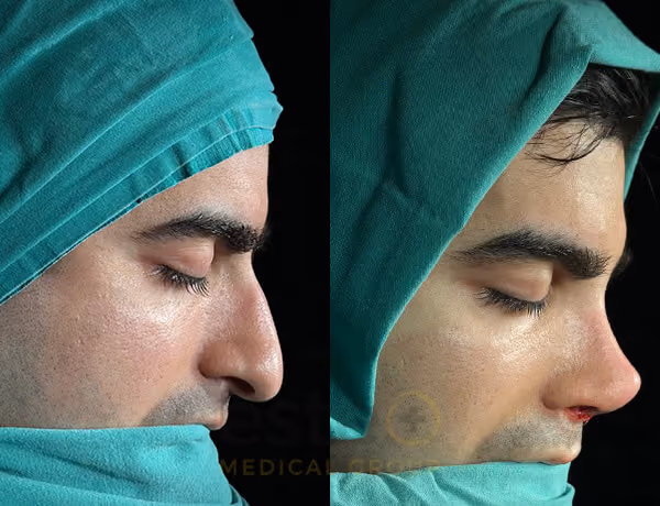 Nose job before-after results with Este Medical