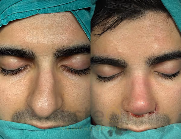 Nose job before-after results with Este Medical