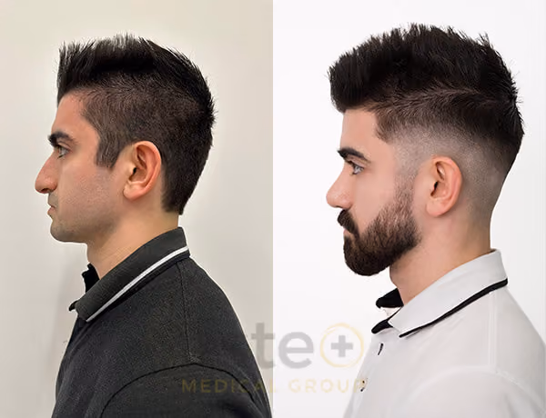 Nose job before-after results with Este Medical