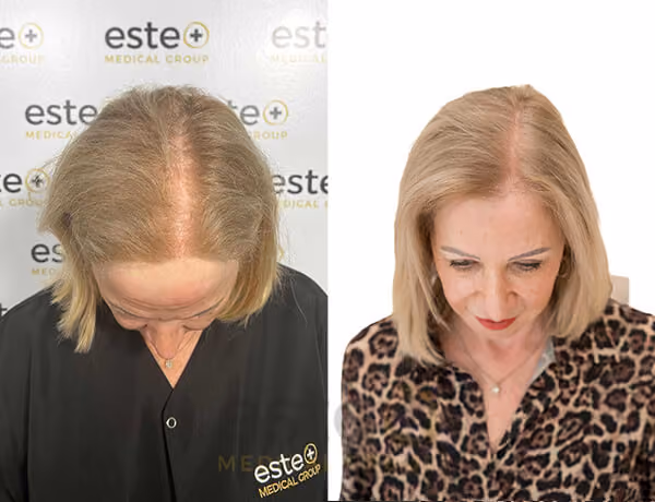 Hair transplant before and after Leeds