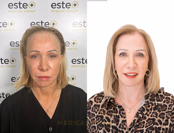 Gwyneth Macdonald - Hair Transplant with Este Medical