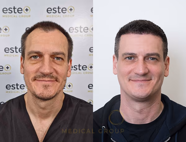 Hair transplant Men
