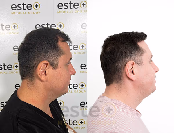 Hair transplant Men