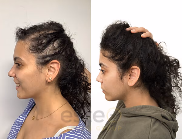 Rawan Hair Regrowth Results - Este Medical