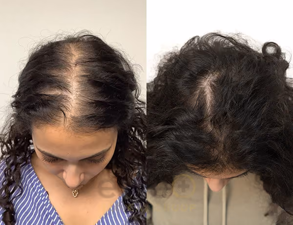 Rawan Hair Regrowth Results - Este Medical