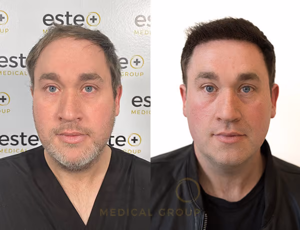 hair transplant turkey cost