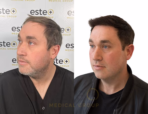 Best hair transplant results 