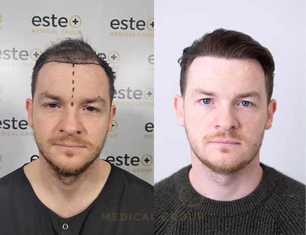 hair transplant in turkey cost