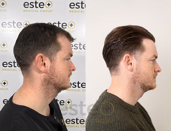 cost of hair transplant in turkey