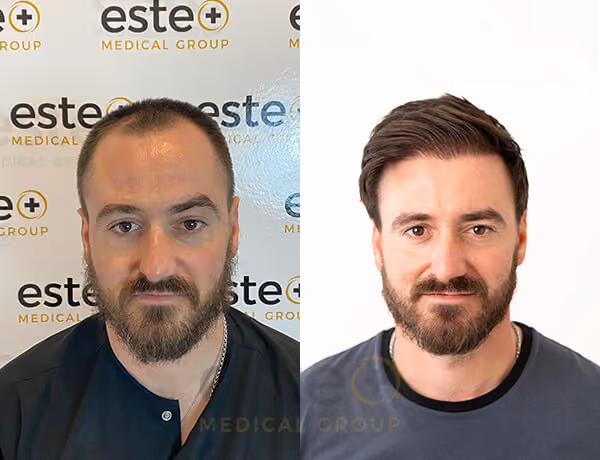 Before and after turkey hair transplant 