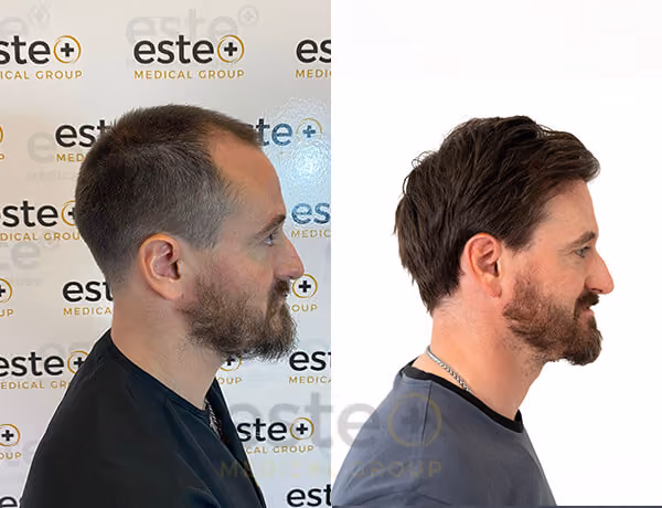 Hair transplant turkey results 