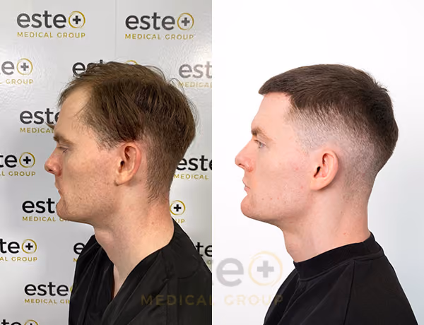 Hair transplant before and after Leeds