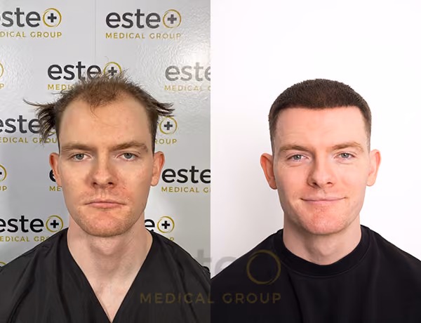 Hair transplant before and after Leeds