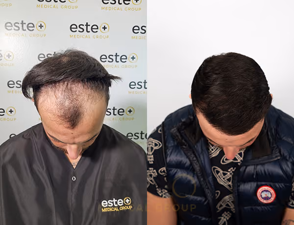 Hair transplant Men