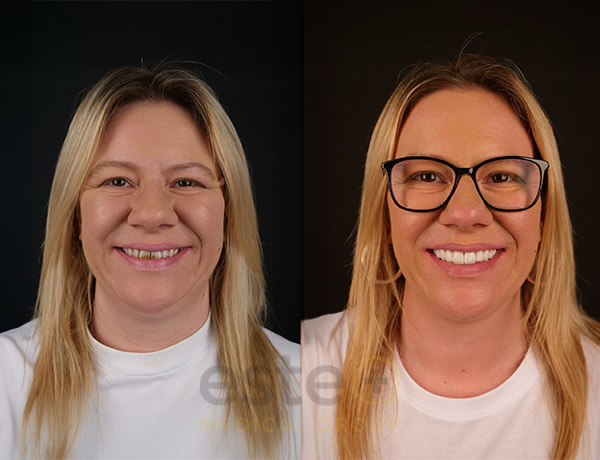Emma Dental Before After Results with Este