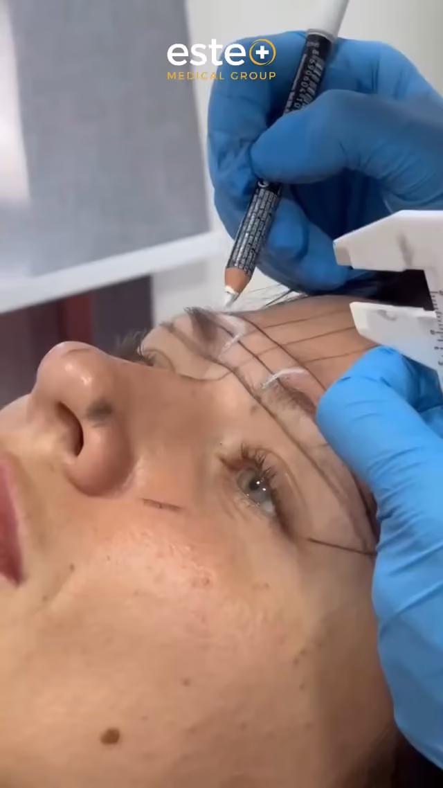 Eyebrow Transplant Results with Este Medical