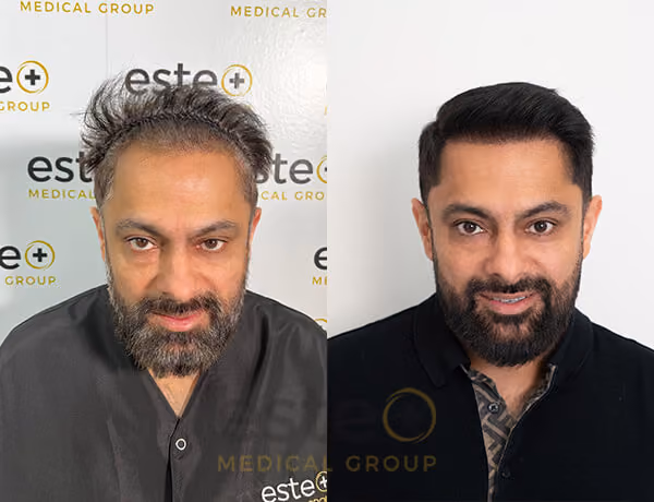 Hair transplant before and after Leeds