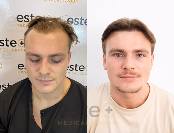 Hair transplant before and after Leeds