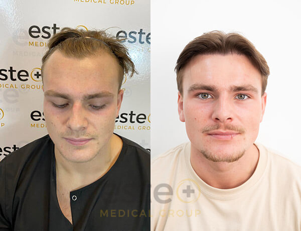 Hair transplant before and after Leeds